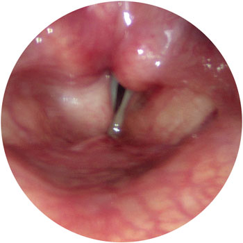 Left vocal fold paralysis in voicing with poor closure