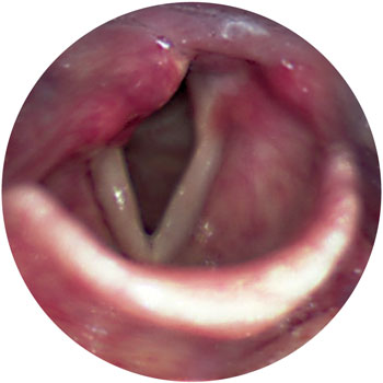 Paralysed right vocal fold: paralysed fold lies between the open and closed position in breathing.