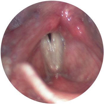Well compensated right vocal fold paralysis in voicing with good closure. Note the minimal posterior gap and the compensatory movement of the left fold across the midline.