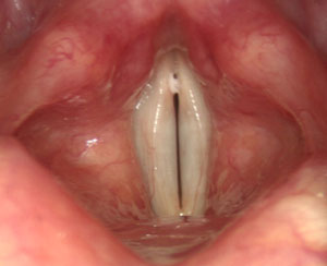 Green Lumps Throat 59