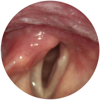 Right vocal fold paralysis in breathing – paralysed fold close to the midline
