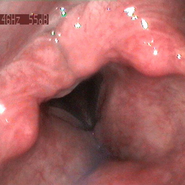 Swollen and inflamed larynx