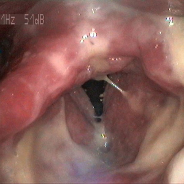 Swollen larynx coated in thick mucus